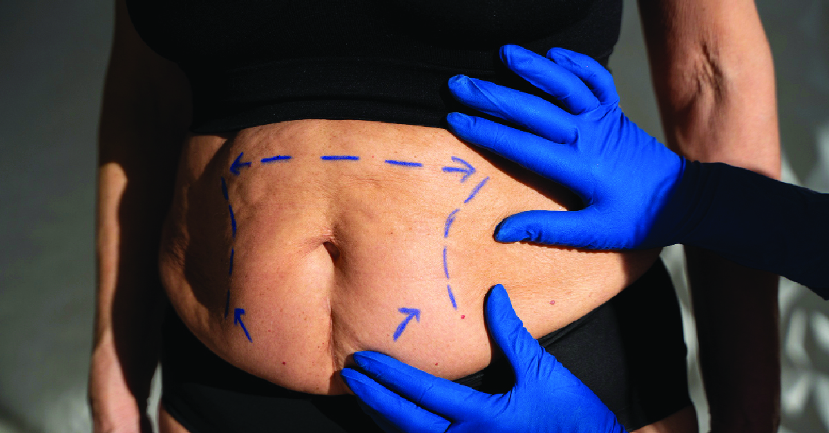 Body Contouriing Pattern Understanding Body Contouring: What You Need to Know