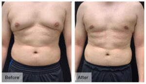 GYNECOMASTIA Surgeon