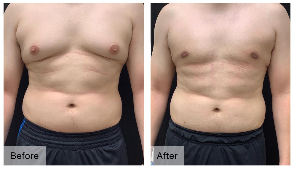 GYNECOMASTIA Surgeon